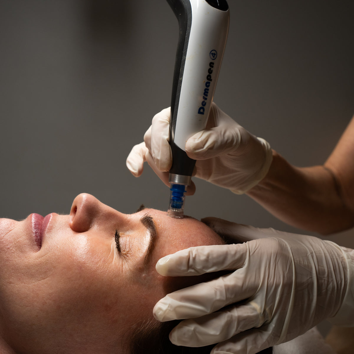 Dermapen4 skin needling treatment on a client's forehead at Amavi Beauty Lounge in Red Hill, Brisbane