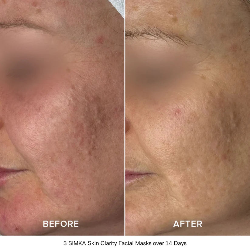 Simka Skin Clarity Bio-Cellulose Face Mask (4 Pack)